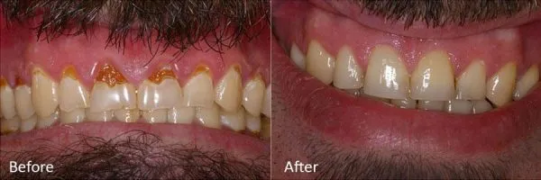 Before & After Gallery Image