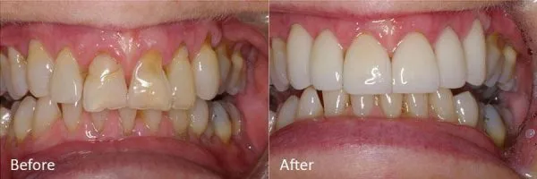 Before & After Gallery Image