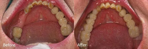 Before & After Gallery Image
