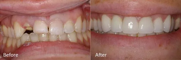 Before & After Gallery Image