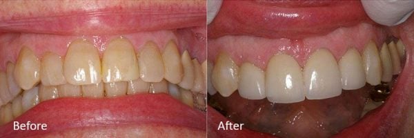 Before & After Gallery Image