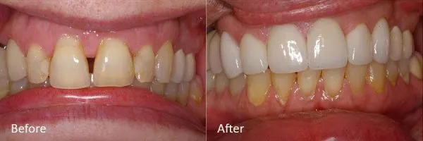 Before & After Gallery Image