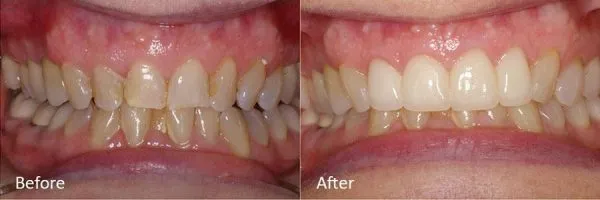 Before & After Gallery Image