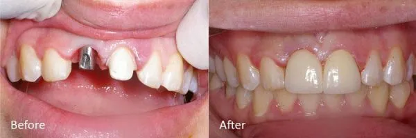 Before & After Gallery Image