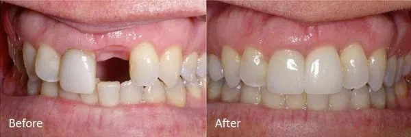 Before & After Gallery Image