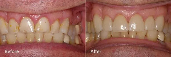 Before & After Gallery Image