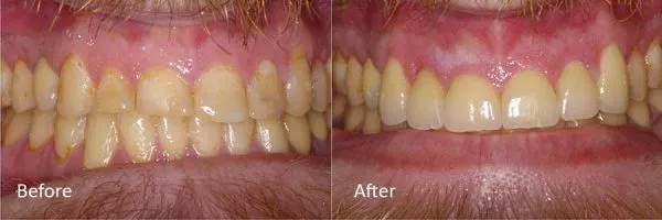 Before & After Gallery Image