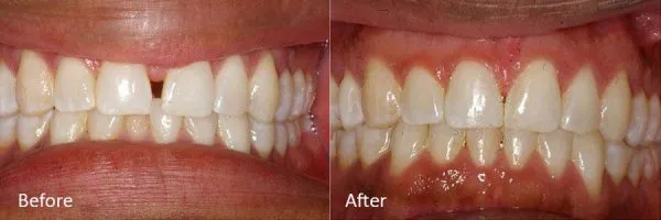 Before & After Gallery Image