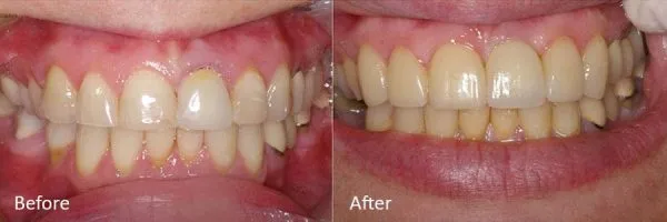 Before & After Gallery Image