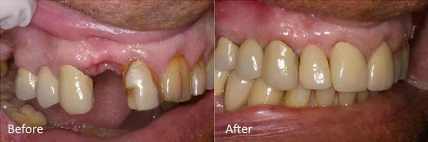 Before & After Gallery Image