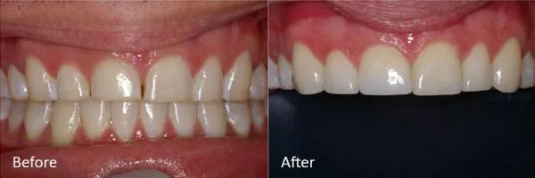 Before & After Gallery Image