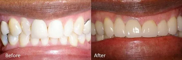 Before & After Gallery Image
