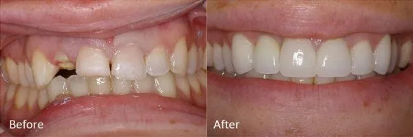 Before & After Gallery Image