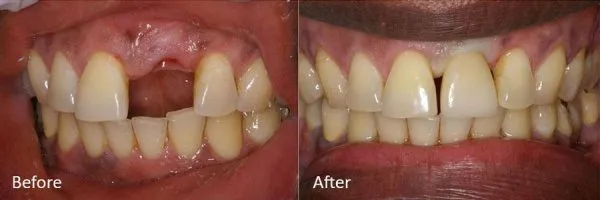 Before & After Gallery Image